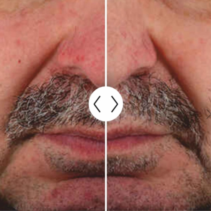 Сыворотка-Крем для Кожи Лица с Розацеа Zein Obagi Rozatrol Treatment For Red Sensitized Skin