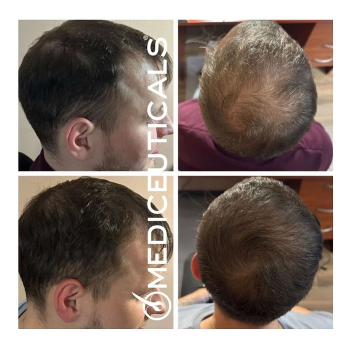 Набор для Стимуляции Роста Тонких и Истонченных Волос Mediceuticals Advanced Hair Restoration Kit